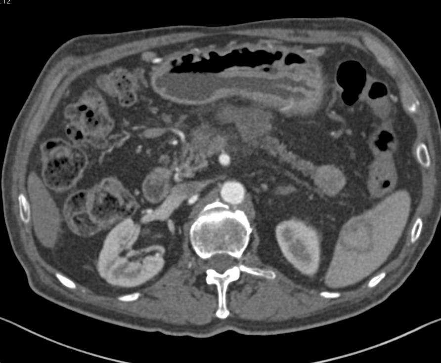 Neuroendocrine Tumor in Tail of the Pancreas - CTisus CT Scan