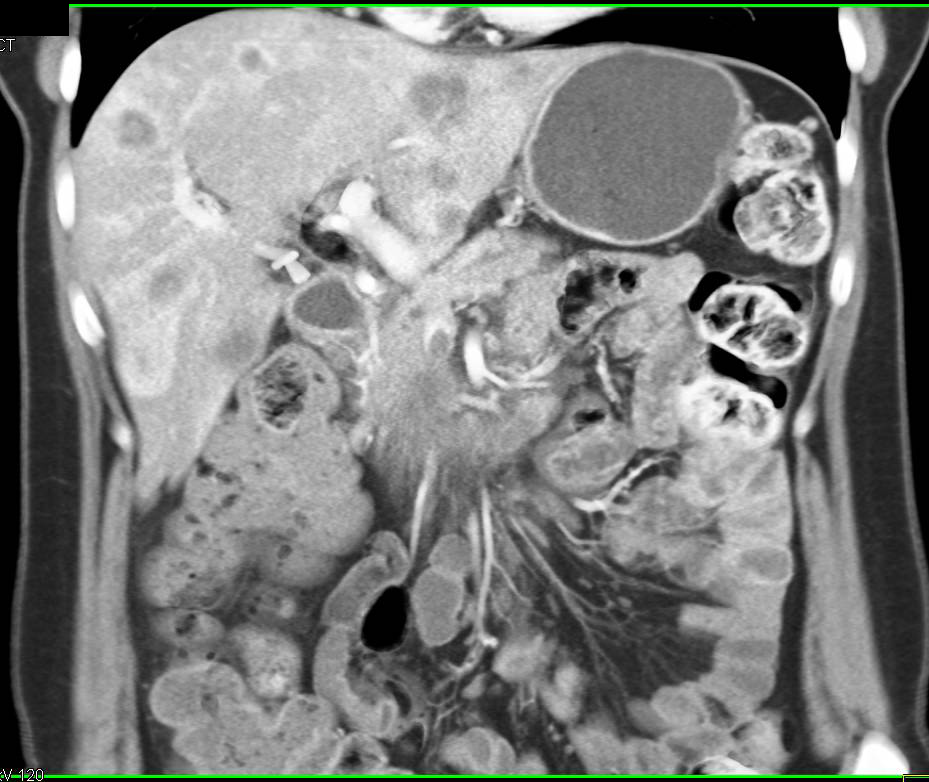 Pancreatic Cancer Invades the Portal Vein and SMV with Clot in PV and Superior Mesenteric Vein (SMV) - CTisus CT Scan