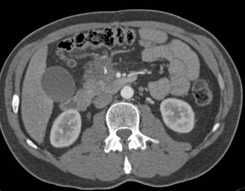 Pancreatic Cancer in a Patient with Chronic Pancreatitis - CTisus CT Scan