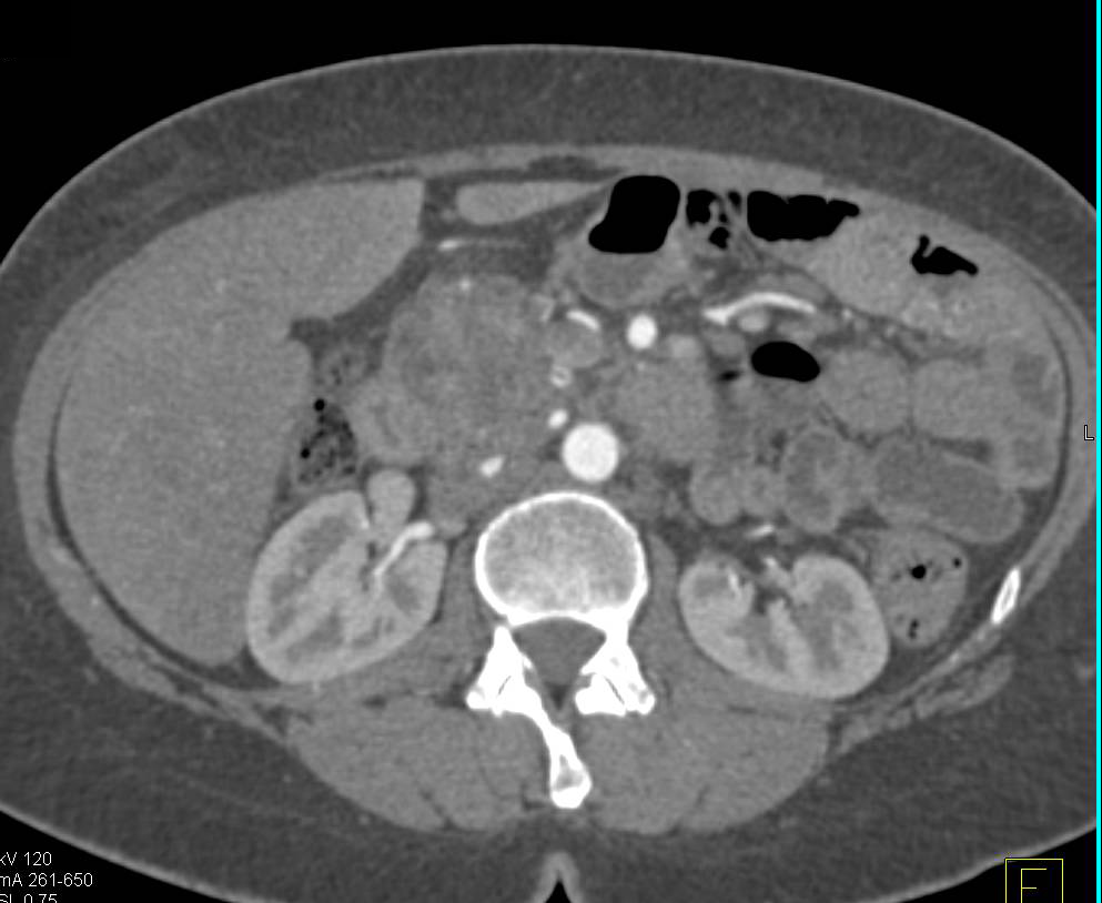 Autoimmune Pancreatitis Simulates a Pancreatic Mass - CTisus CT Scan