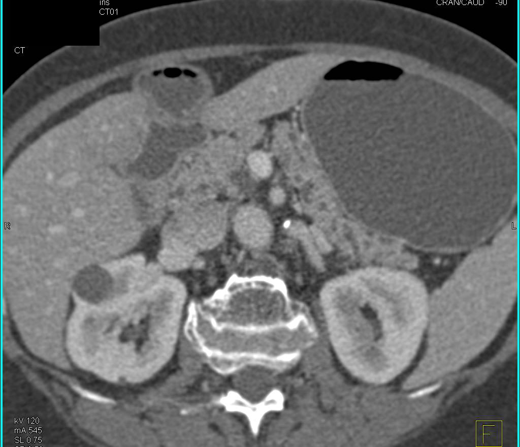 Intraductal Papillary Mucinous Neoplasms (IPMNs) with Mildly Dilated Pancreatic Duct - CTisus CT Scan