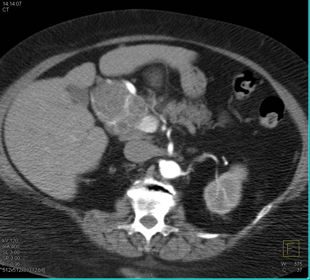 Serous Cystadenoma of the Pancreas - CTisus CT Scan