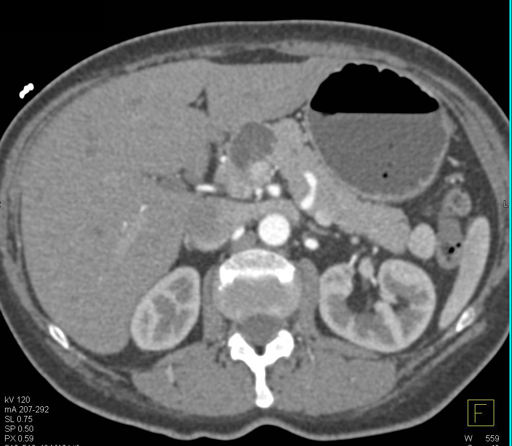 Intraductal Papillary Mucinous Neoplasm (IPMN) in Head of Pancreas and an Accessory Spleen Near Tail Simulating a Lesion - CTisus CT Scan