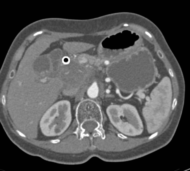 Adenocarcinoma of the Head of the Pancreas with Vessel Encasement Especially of the Portal Vein with Distended Gallbladder - CTisus CT Scan