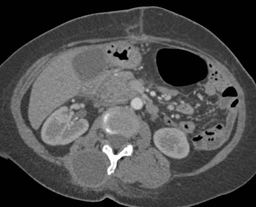 Pancreatic Cancer with a Mass in the Right Paraspinal Muscles - CTisus CT Scan