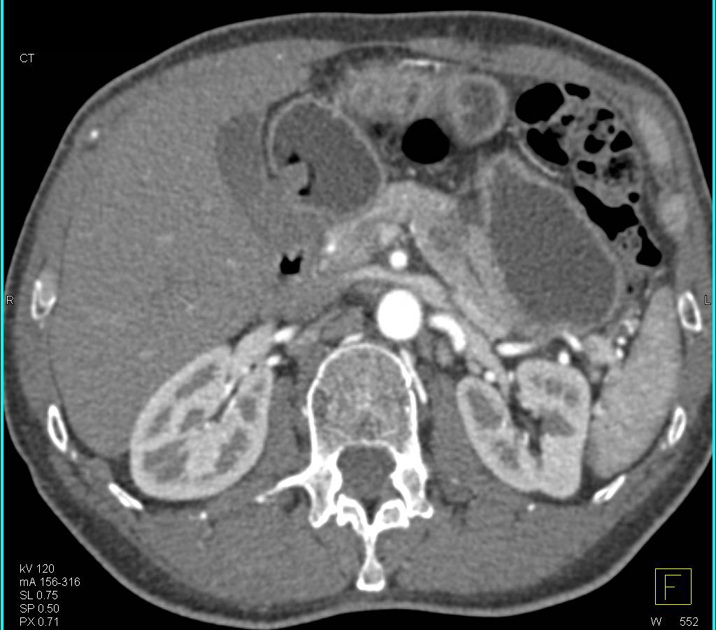 Intraductal Papillary Mucinous Neoplasm (IPMN) in Tail of Pancreas - CTisus CT Scan