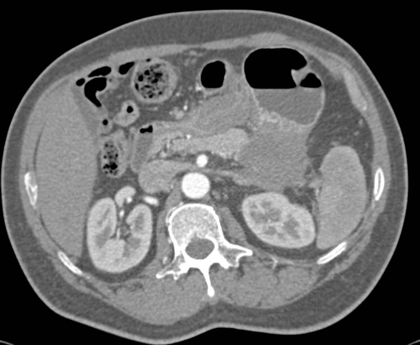 Carcinoma Tail of Pancreas with Splenic Vein Occlusion - CTisus CT Scan