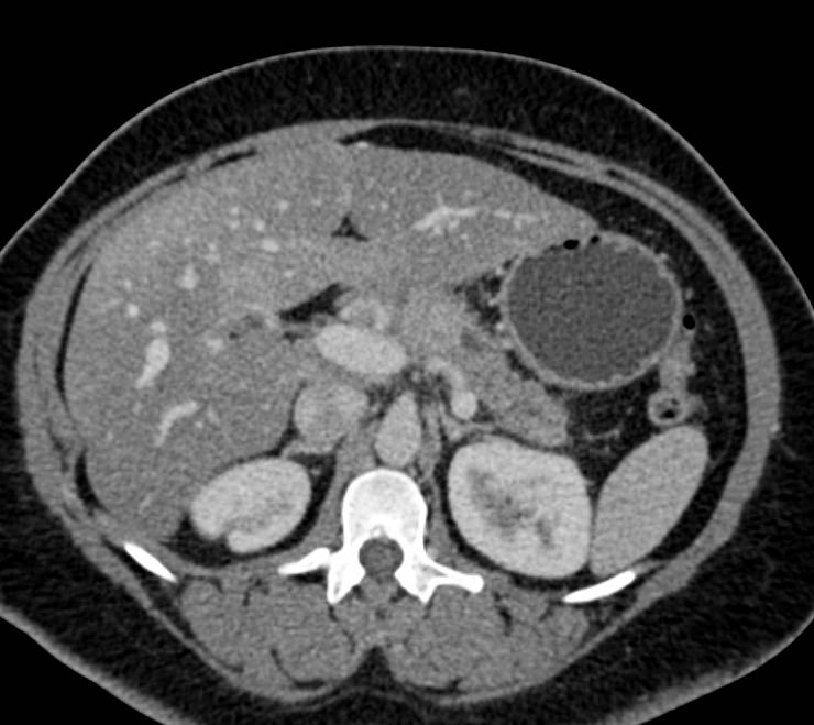 Neuroendocrine Tumor in Neck of the Pancreas - CTisus CT Scan