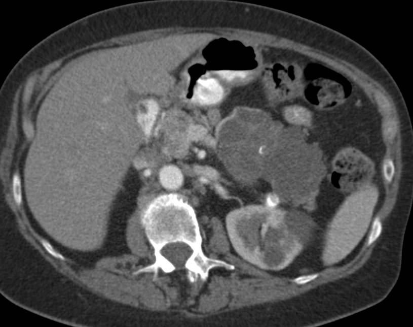 Serous Cystadenoma of the Pancreas - CTisus CT Scan