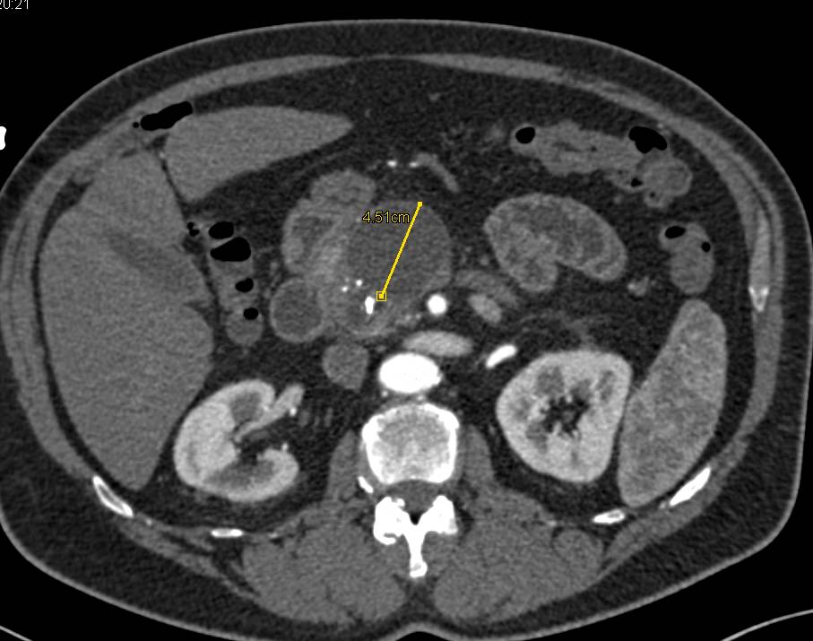 Acute and Chronic Pancreatitis with a Pseudocyst - CTisus CT Scan