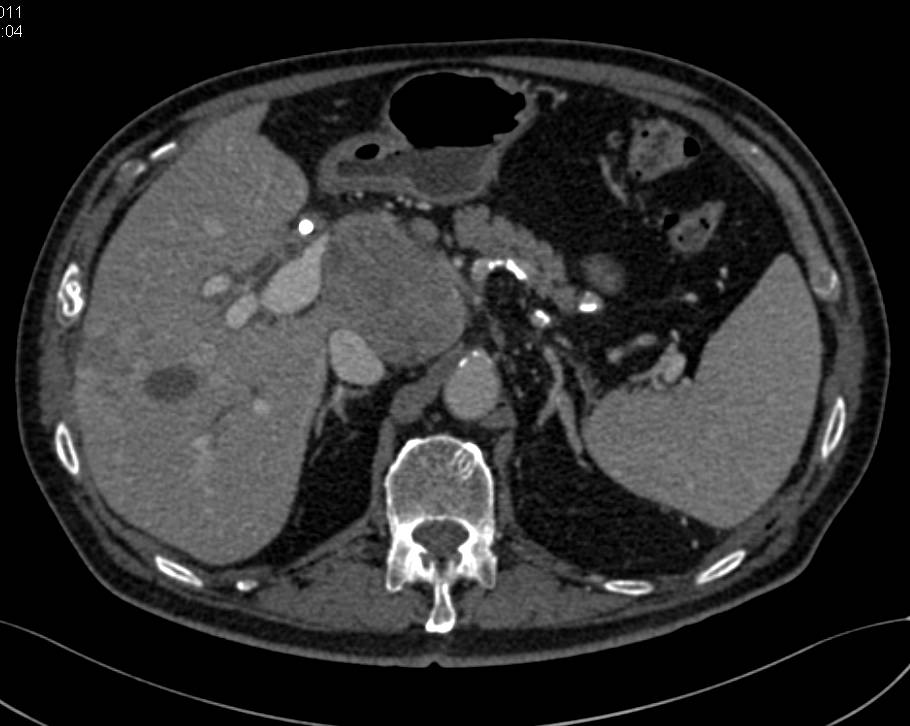 Neuroendocrine Tumor with Liver Metastases - CTisus CT Scan