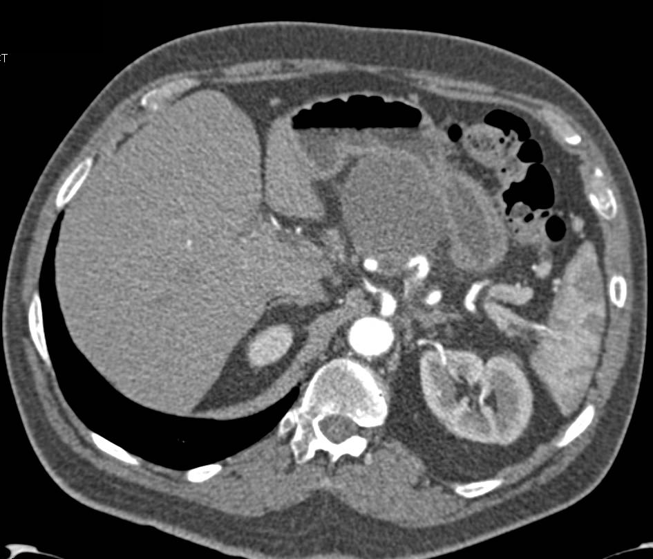 Mucinous Cystic Neoplasm of the Pancreas (MCN) - CTisus CT Scan