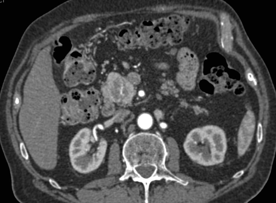 Neuroendocrine Tumor in the Head of the Pancreas - CTisus CT Scan