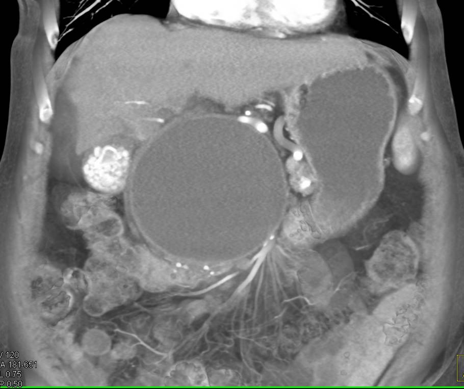 Large Pseudocyst in Patient with Chronic Pancreatitis - CTisus CT Scan