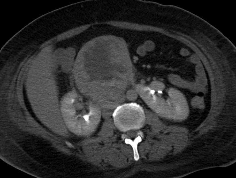 Neuroendocrine Tumor in the Head of the Pancreas - CTisus CT Scan