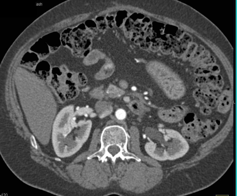 Multiple Neuroendocrine Tumors in the Head of the Pancreas - CTisus CT Scan