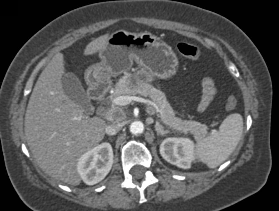 Adenocarcinoma of the Pancreas Arising in an Intraductal Papillary Mucinous Neoplasm (IPMN) - CTisus CT Scan