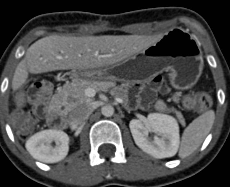 Melanoma Metastatic to the Head of Pancreas-1 cm Lesion - CTisus CT Scan