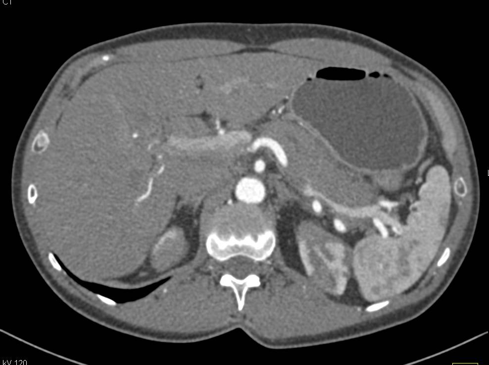 Incredible Case of Autoimmune Pancreatitis and Renal Infarcts - CTisus CT Scan