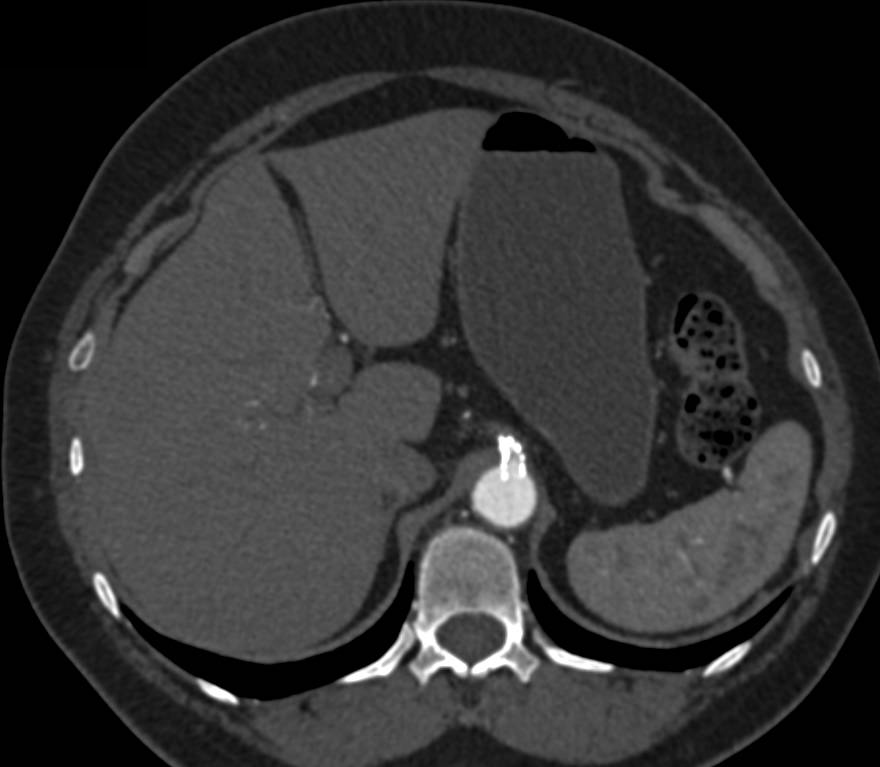 Gastroduodenal Artery (GDA) Aneurysm near the Head of the Pancreas ...