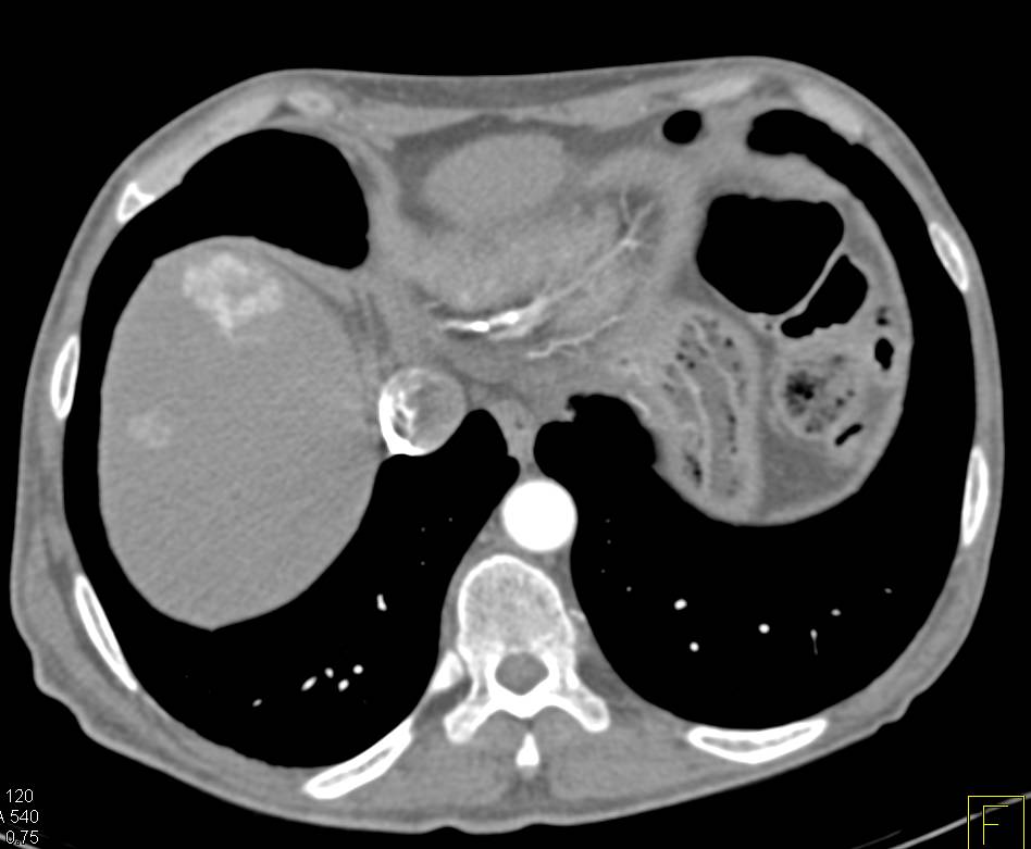 Neuroendocrine Tumor in Body of Pancreas with Vascular Liver Metastases and Portal Vein Invasion - CTisus CT Scan