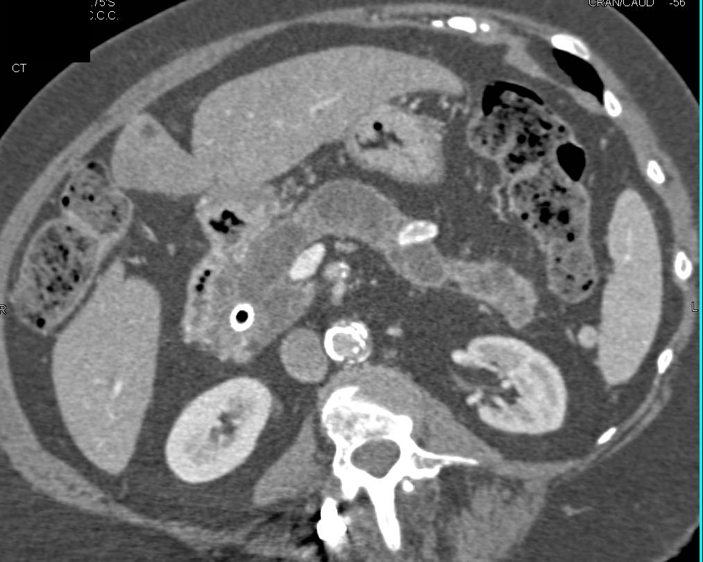 Central Intraductal Papillary Mucinous Neoplasm (IPMN) with a Carcinoma - CTisus CT Scan