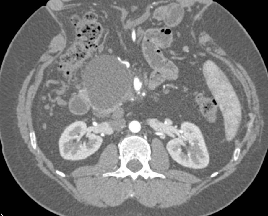 Serous Cystadenoma of the Pancreas - CTisus CT Scan