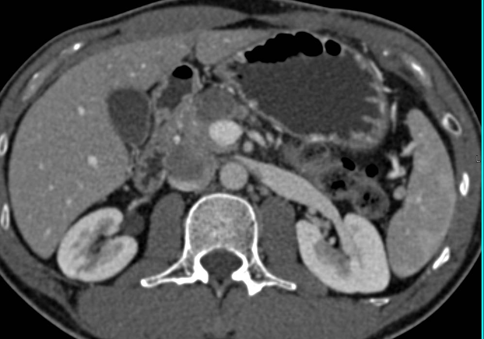 Cystic Metastases to the Pancreas Simulates a Pancreatic Adenocarcinoma - CTisus CT Scan