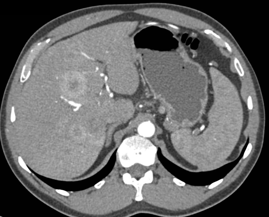 Neuroendocrine Tumor Tail of Pancreas with Liver Metastases - CTisus CT Scan