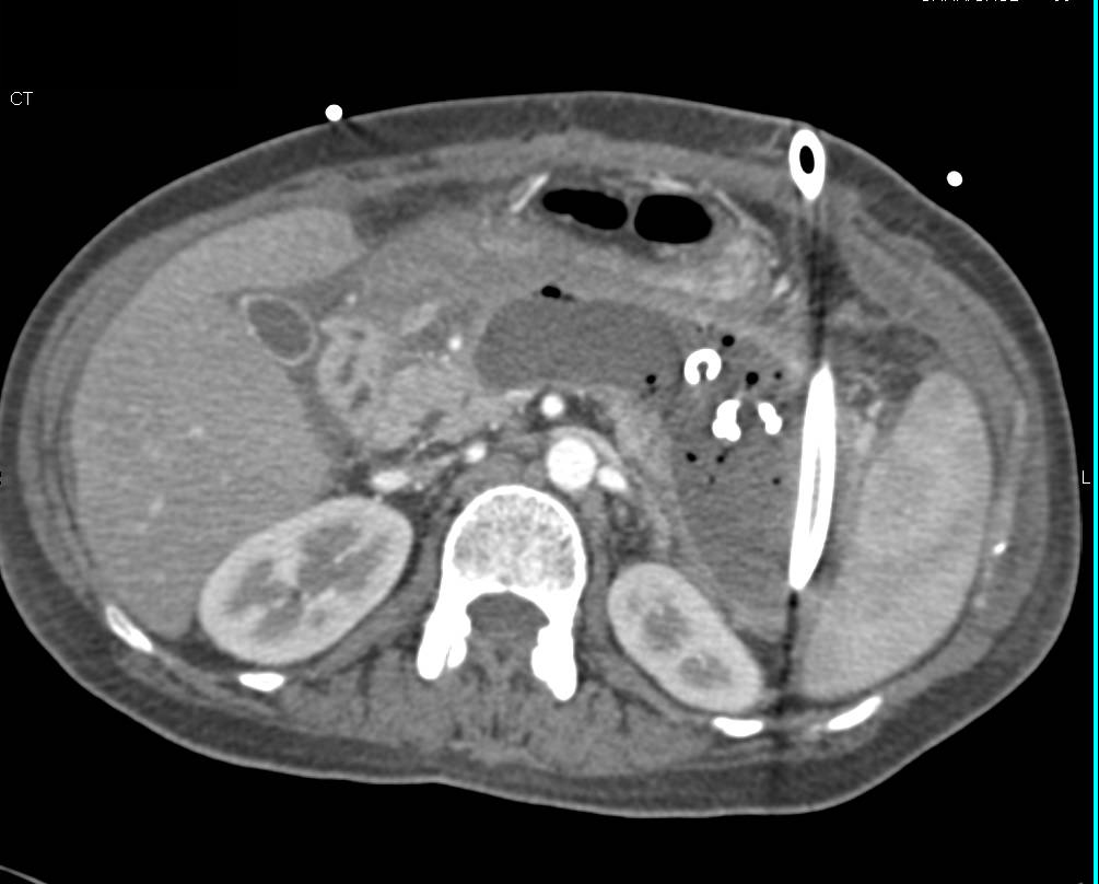 Pancreatic Necrosis with Drain - CTisus CT Scan