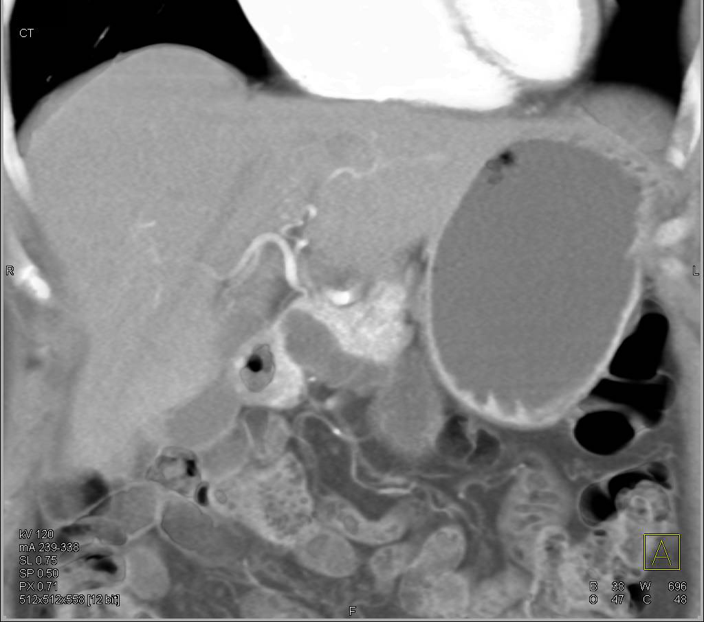 Intraductal Papillary Mucinous Neoplasms (IPMNs) - CTisus CT Scan