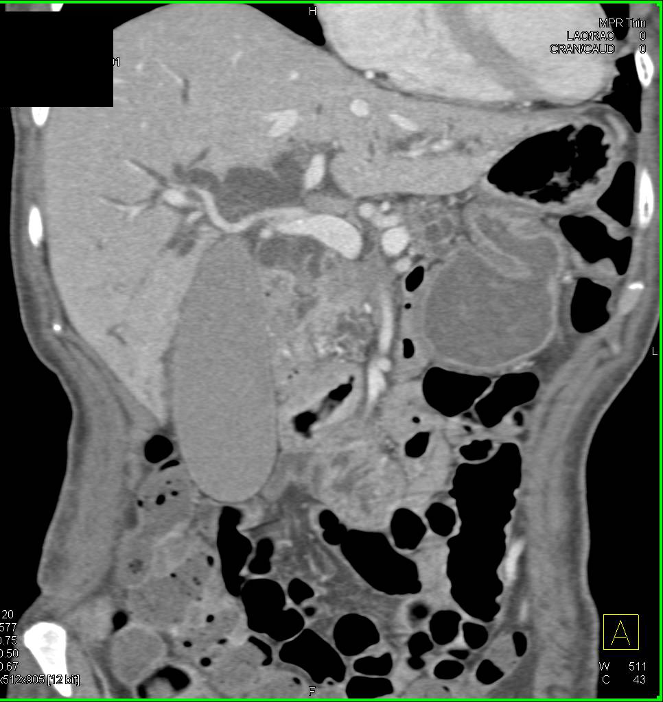 Pancreatic Cancer with Distended Gallbladder - CTisus CT Scan