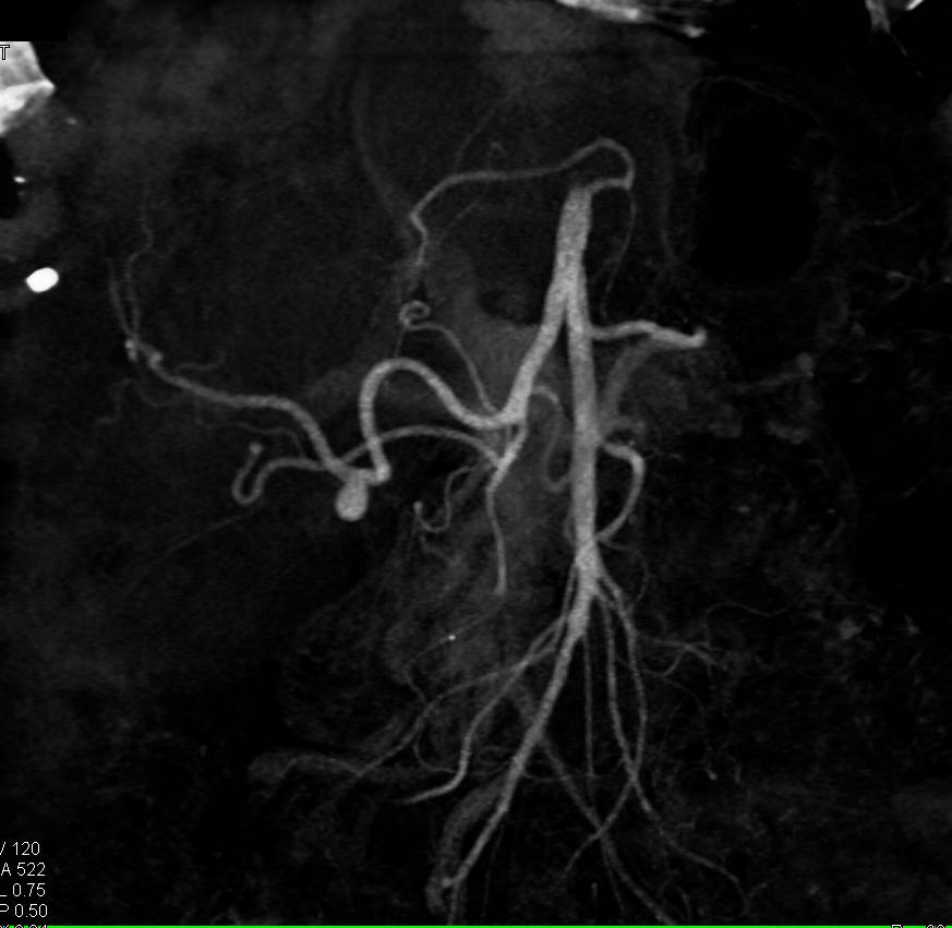 PV/SMV Occlusion by Tumor with Liver Metastases and Hepatic Artery Aneurysm - CTisus CT Scan