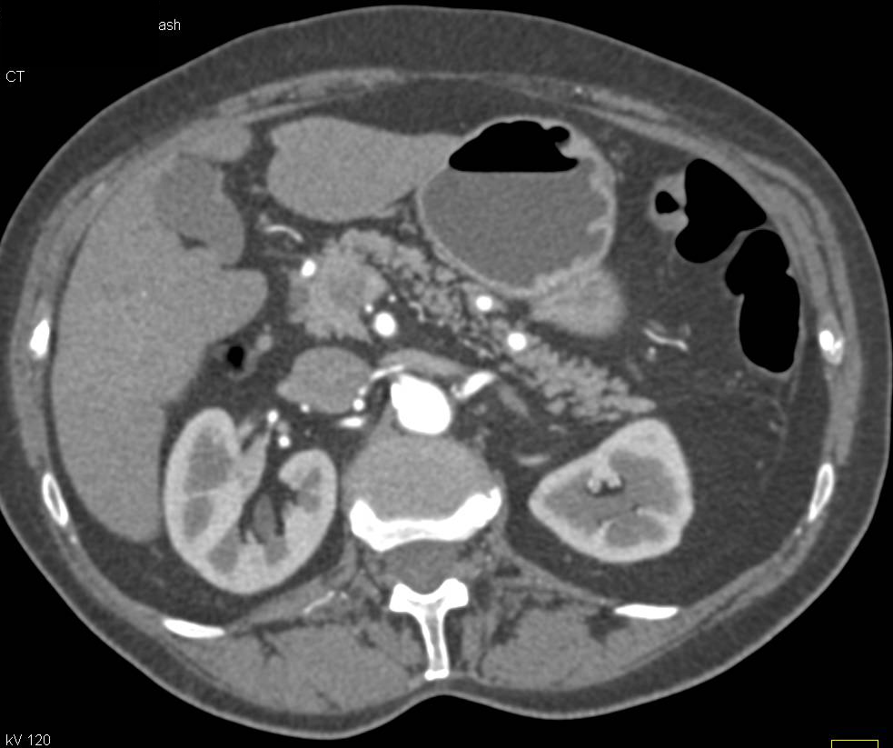 Neuroendocrine Tumor in the Head of the Pancreas - CTisus CT Scan