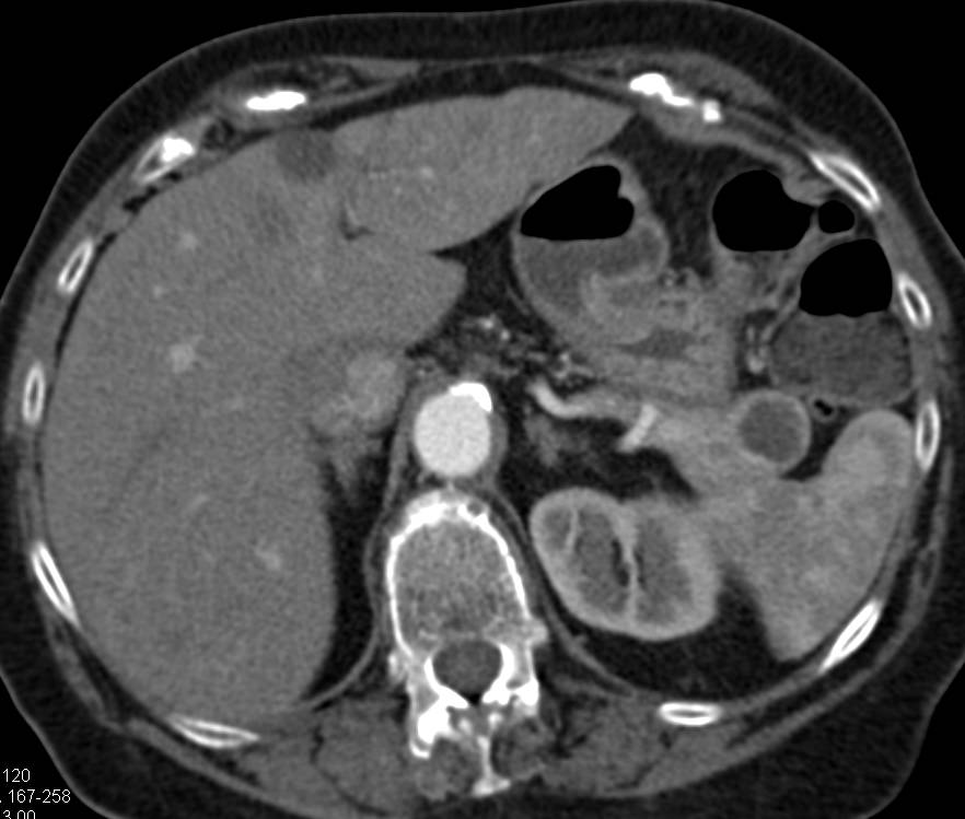 Cystic Neuroendocrine Tumor in Tail of the Pancreas - CTisus CT Scan