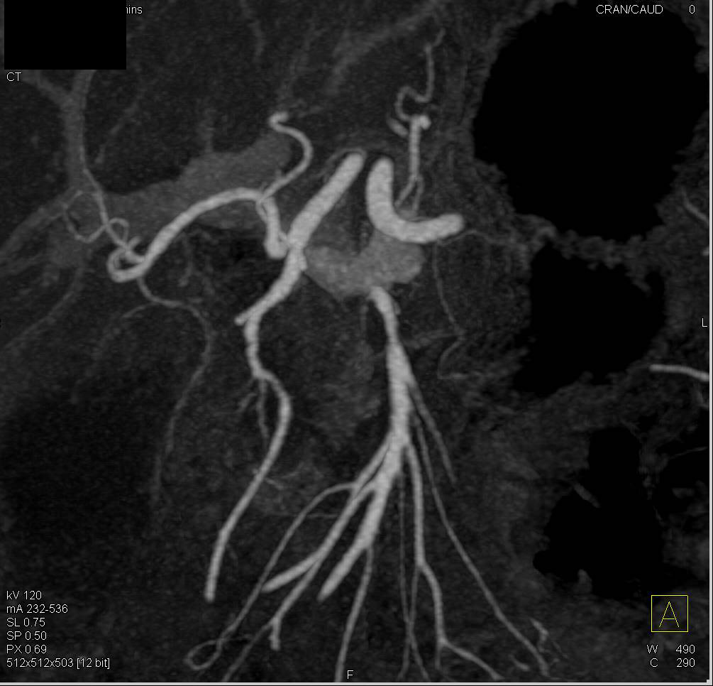 Pancreatic Cancer Encases the Gastroduodenal Artery (GDA) on CTA - CTisus CT Scan