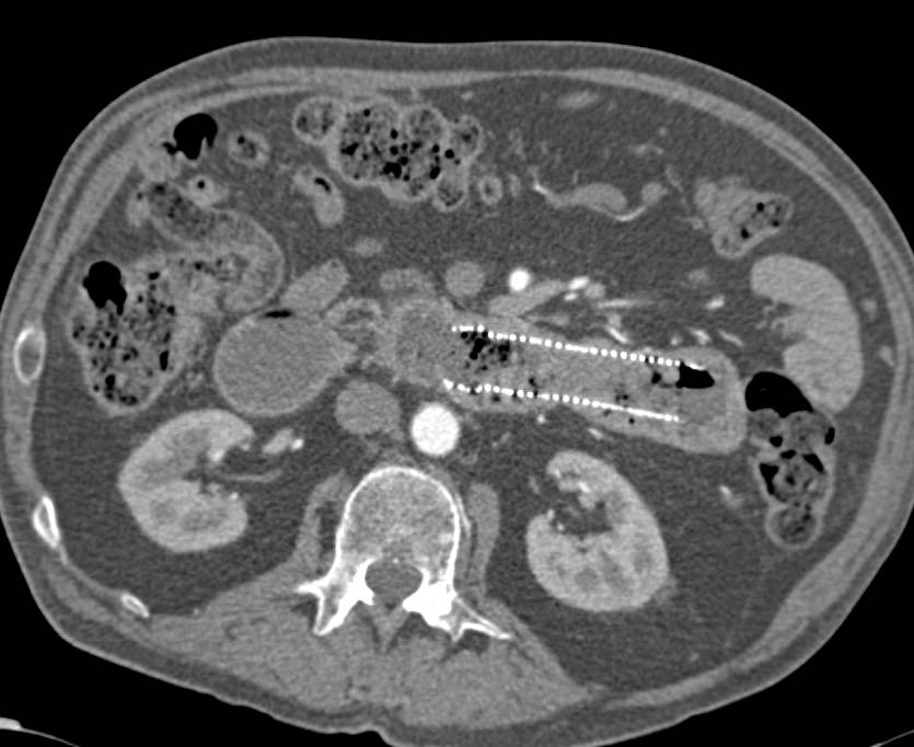 Pancreatic Cancer Invades the 4th Portion of Duodenum with Obstruction and has a Endoluminal Stent Placed - CTisus CT Scan