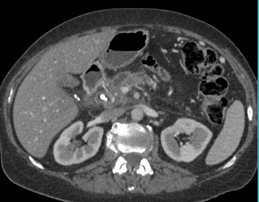 Pancreatic Cancer Encases PV/SMV Junction with Collaterals - CTisus CT Scan