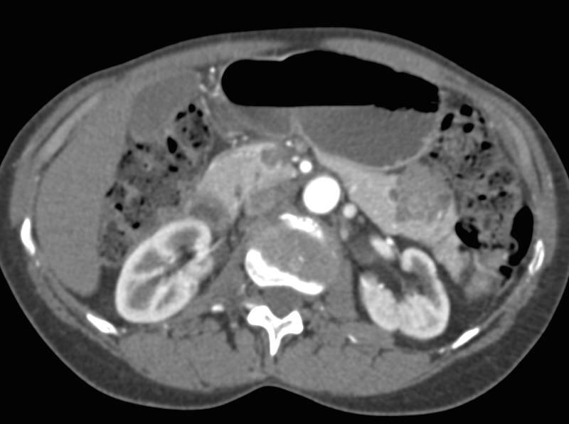 Serous Cystadenoma of the Pancreas in the Tail - CTisus CT Scan