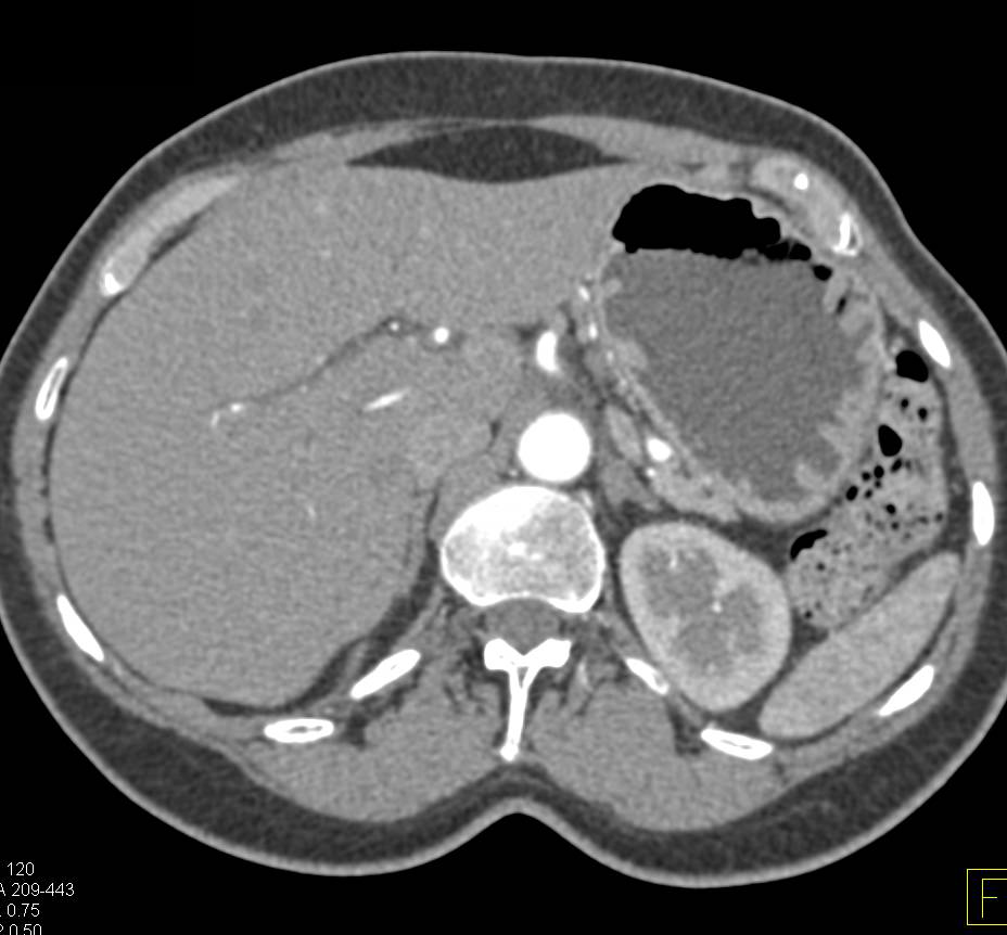 Side Branch IPMN in the Tail of the Pancreas - Pancreas Case Studies ...