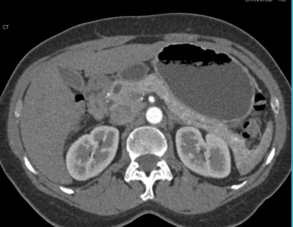 Mildly Dilated Pancreatic Duct Without a Mass - CTisus CT Scan