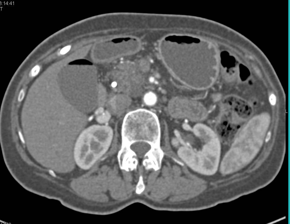 Carcinoma of the Head of the Pancreas Arises in an Intraductal Papillary Mucinous Neoplasm (IPMN) - CTisus CT Scan
