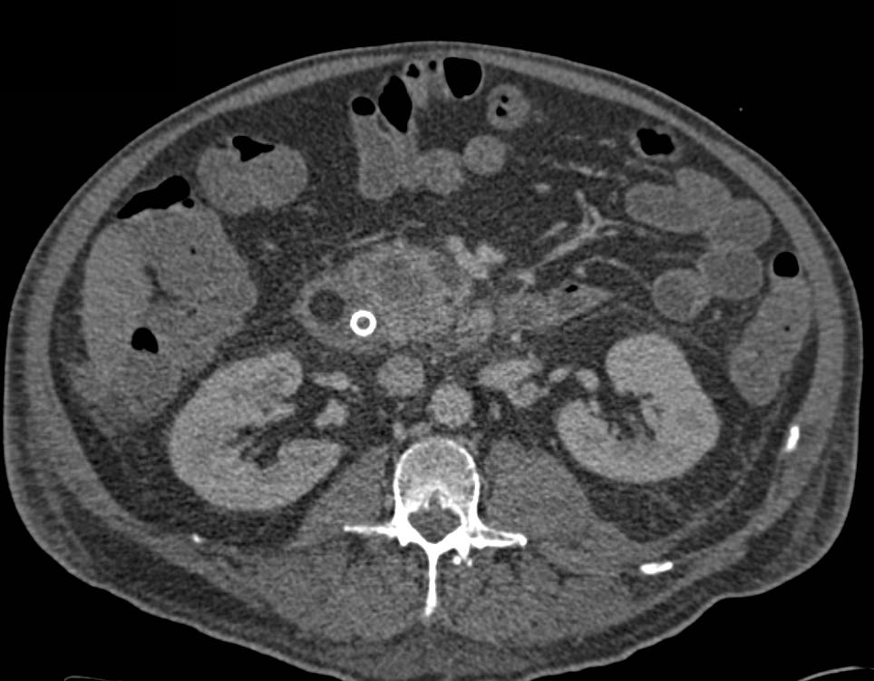 Pancreatc Cancer Encases the Portal Vein . Patient Also Has Multiple Intraductal Papillary Mucinous Neoplasms (IPMNs) - CTisus CT Scan