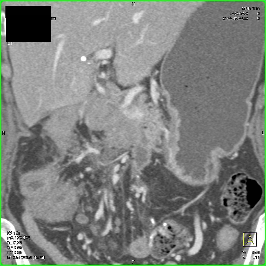 Infiltrating Pancreatic Cancer - CTisus CT Scan