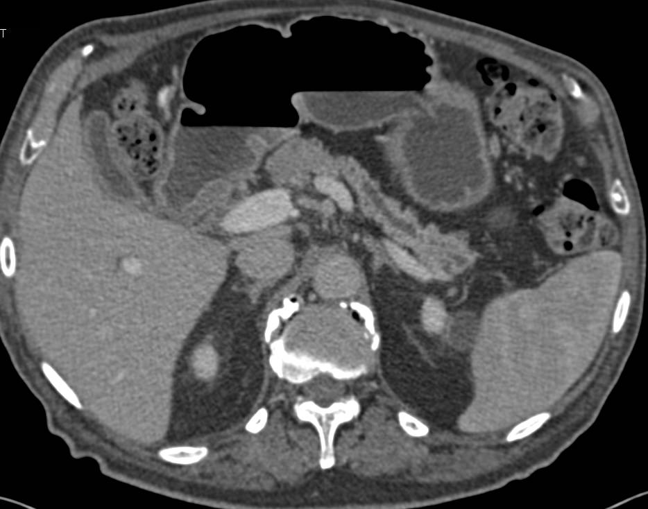 Dilated Pancreatic Duct due to Adenocarcinoma in Neck of Pancreas - CTisus CT Scan