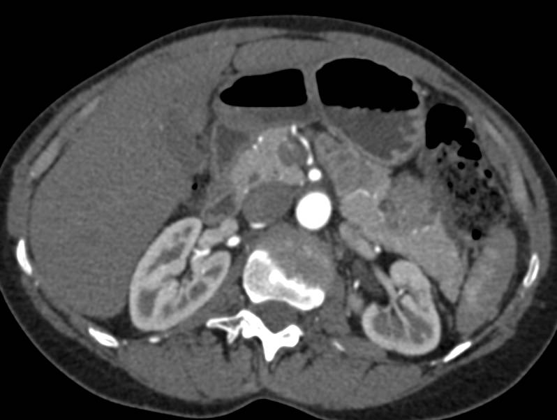 Serous Cystadenoma Tail of Pancreas - CTisus CT Scan