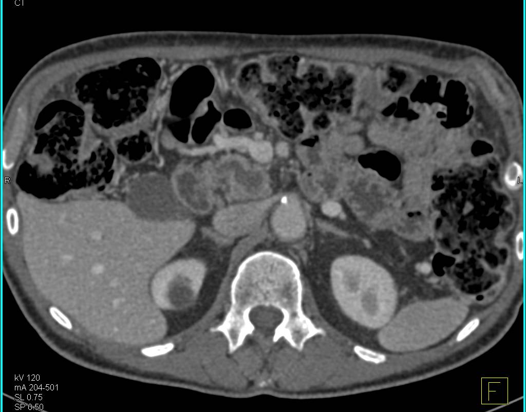 Dilated Pancreatic Duct with Intraductal Papillary Mucinous Neoplasm (IPMN) - CTisus CT Scan