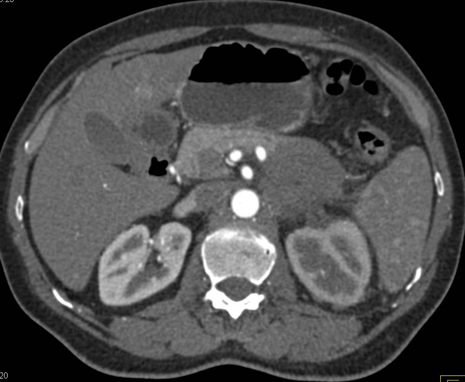 Carcinoma of the Pancreatic Tail also Involves the Left Renal Artery and Vein - CTisus CT Scan