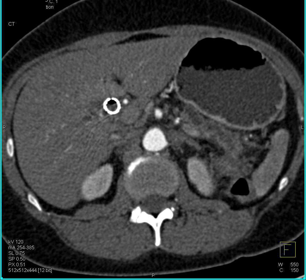 Pancreatic Duct Cutoff due to Carcinoma of the Head of the Pancreas - CTisus CT Scan