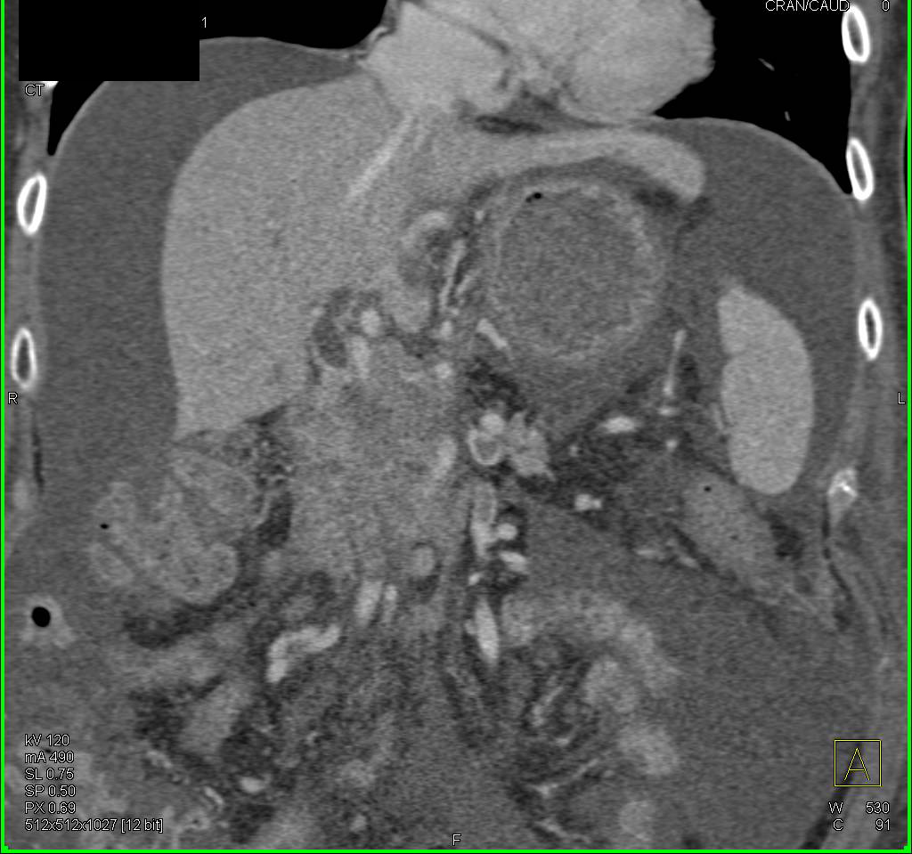 Pancreatic Cancer Encases the Portal Vein and Superior Mesenteric Vein (SMV) - CTisus CT Scan